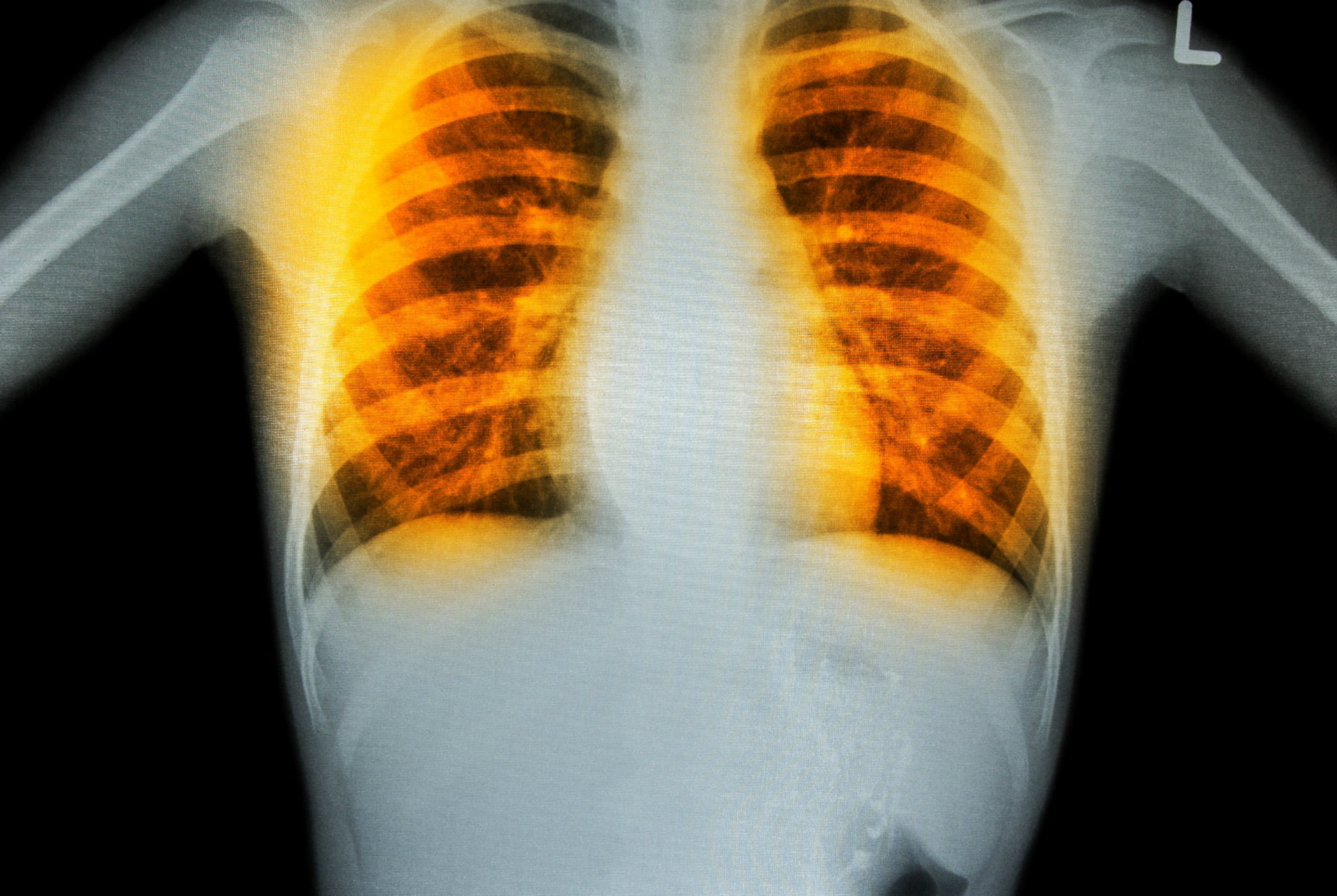 TB and COPD link: lungs highlighted in orange