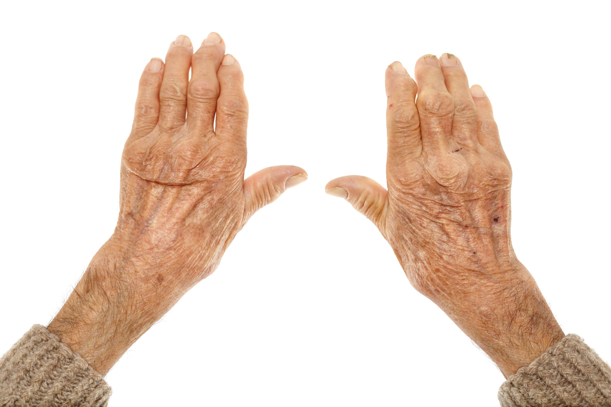 hands with arthritis