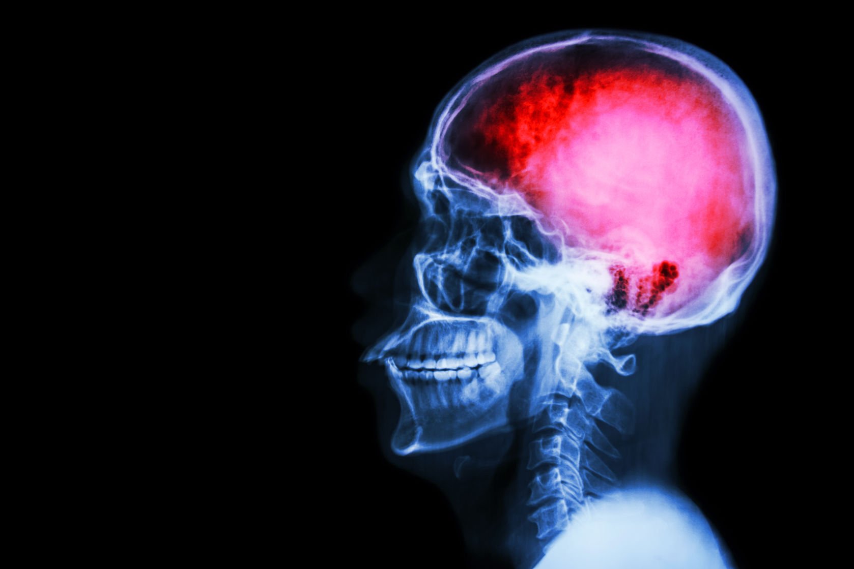 stroke drug: x-ray of skull with brain picked out in pink
