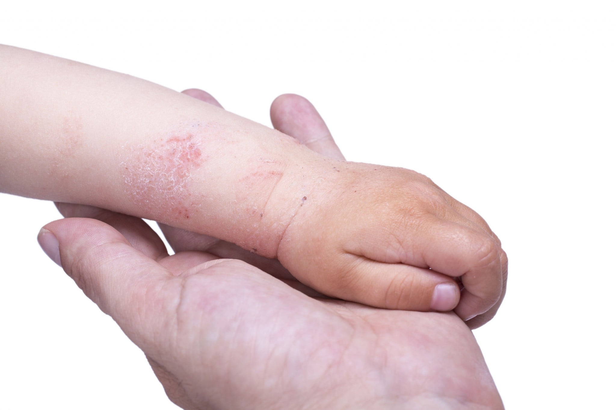 child's arm with eczema