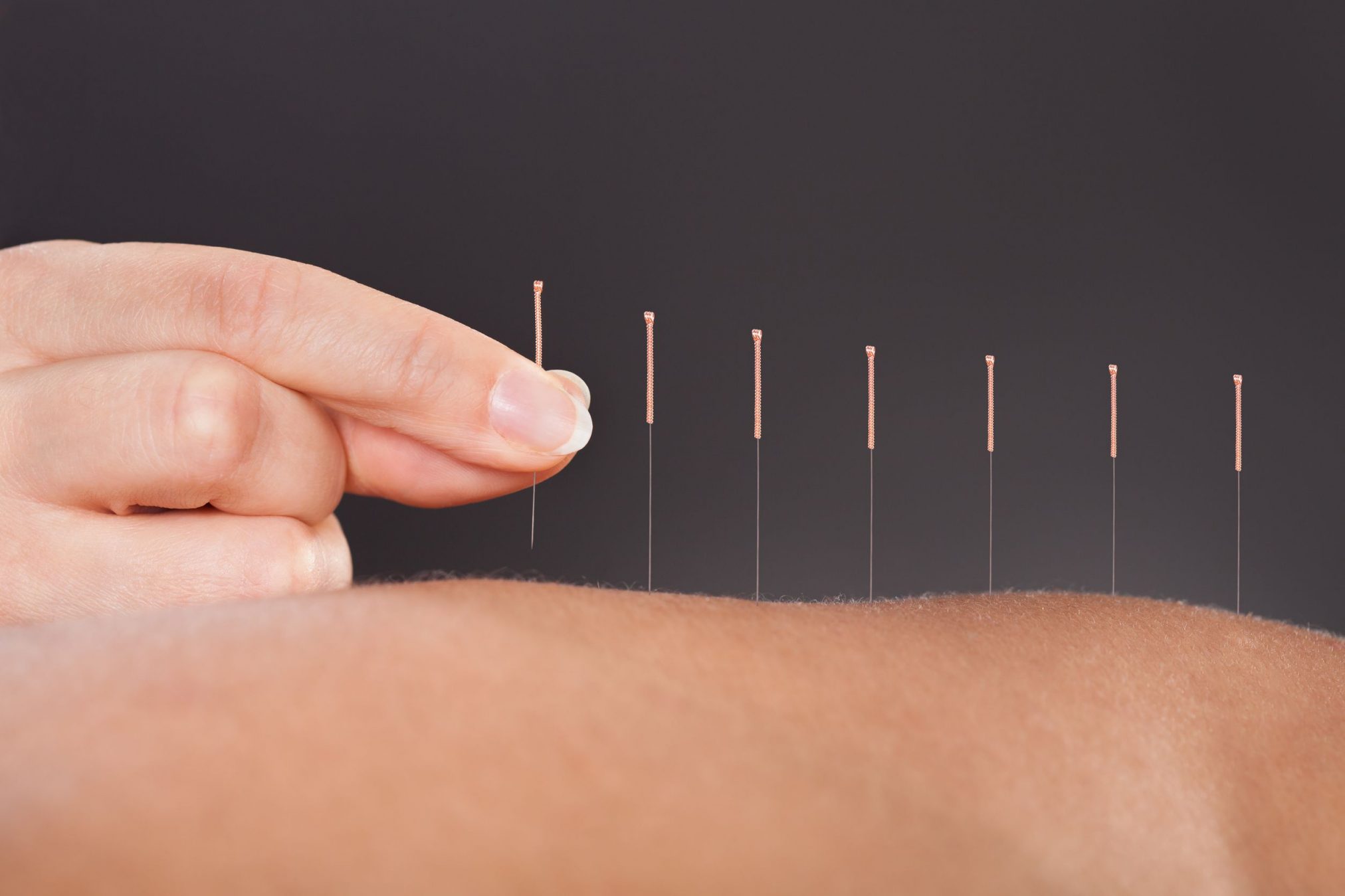 25045894 - close-up of a person getting an acupuncture
