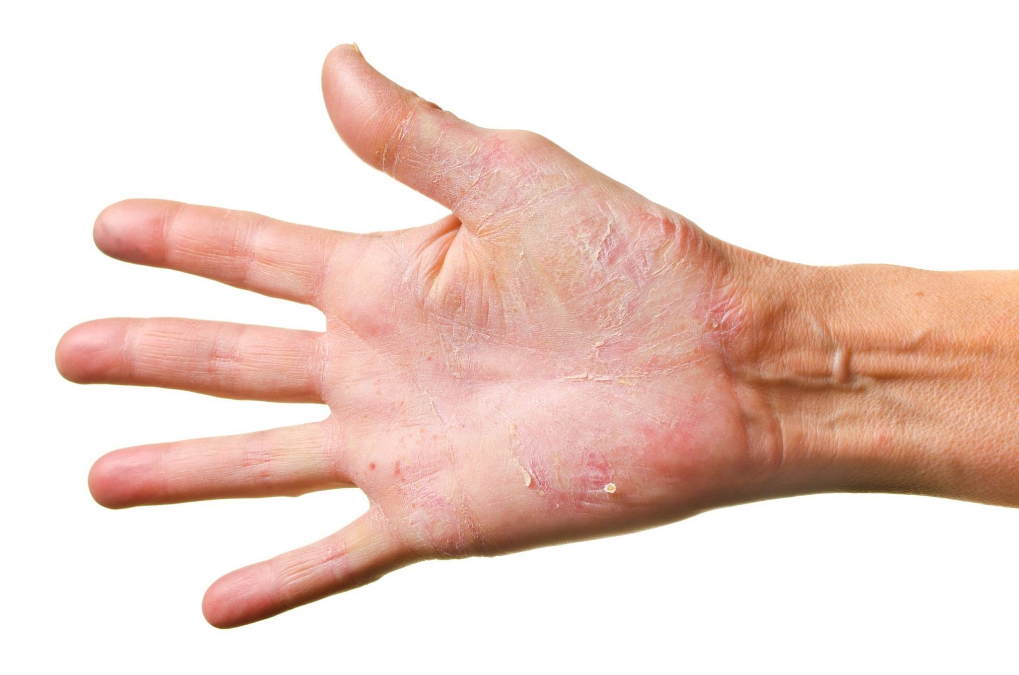 hand with eczema