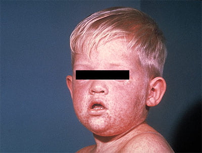 Measles rash on boy