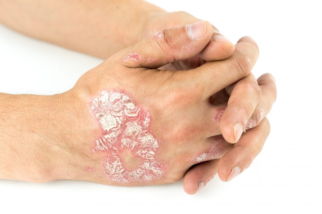 What Is The Underlying Cause Of Psoriasis